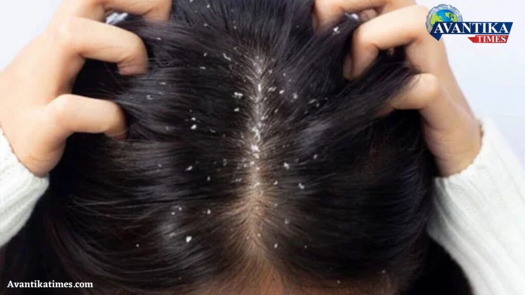 Solve Dandruff Issues Fast